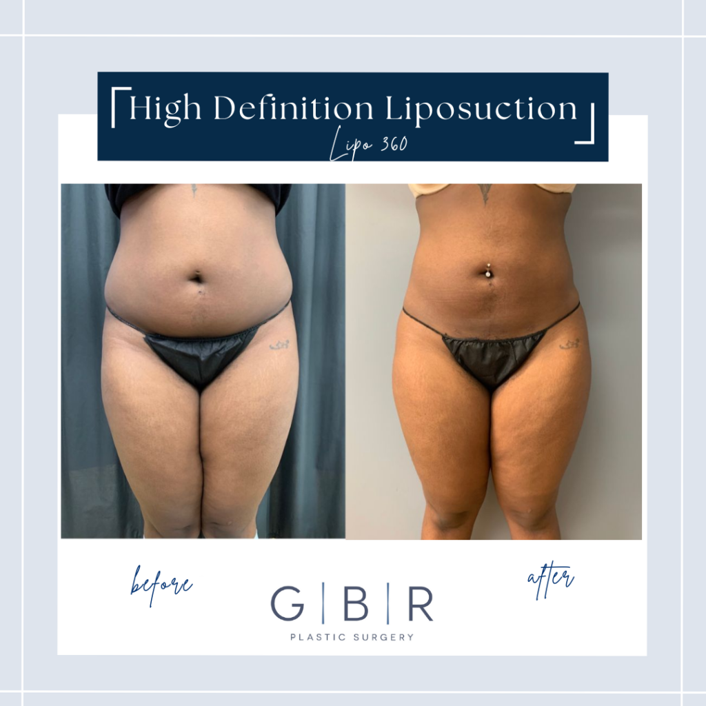 liposuction in virginia beach