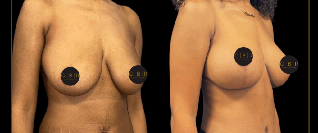breast lift in virginia beach