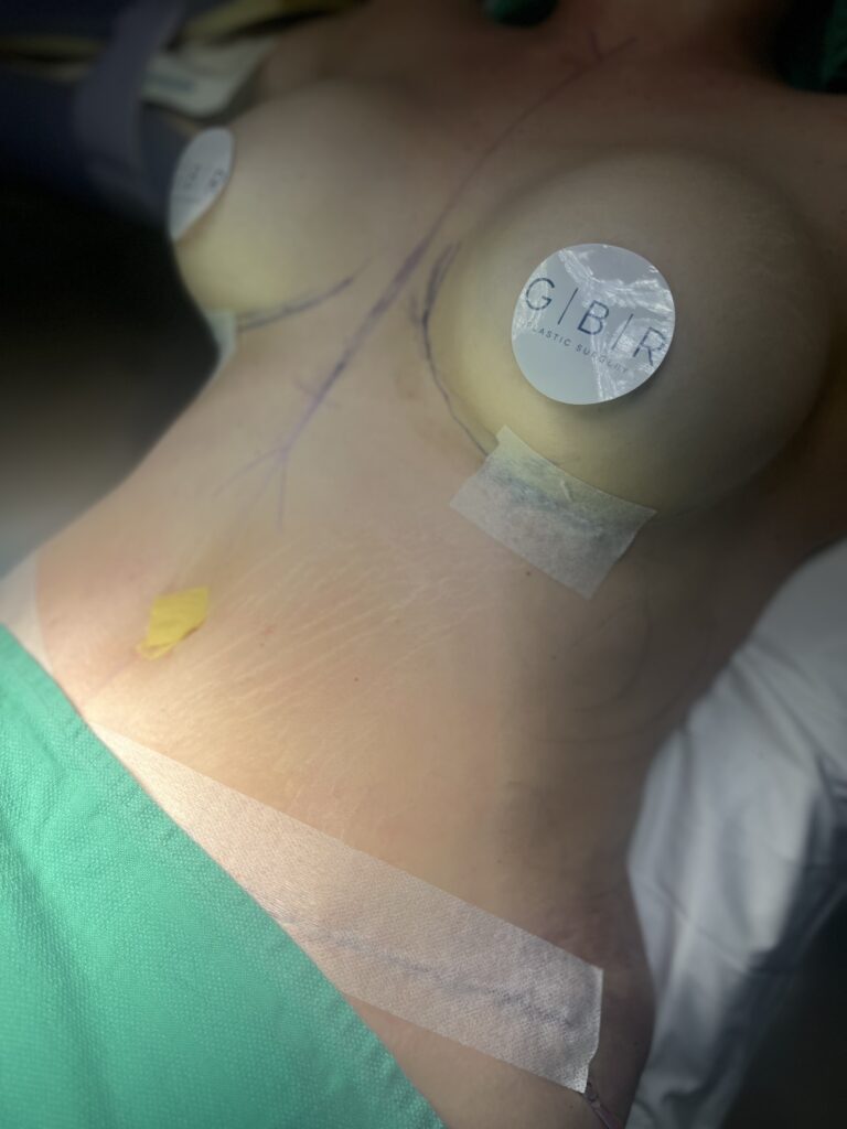 boob augmentation in Virginia beach