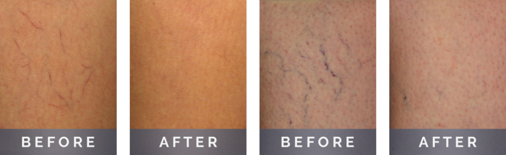 Treatment Results: Uncomplicated spider veins treated with Asclera 0.5%