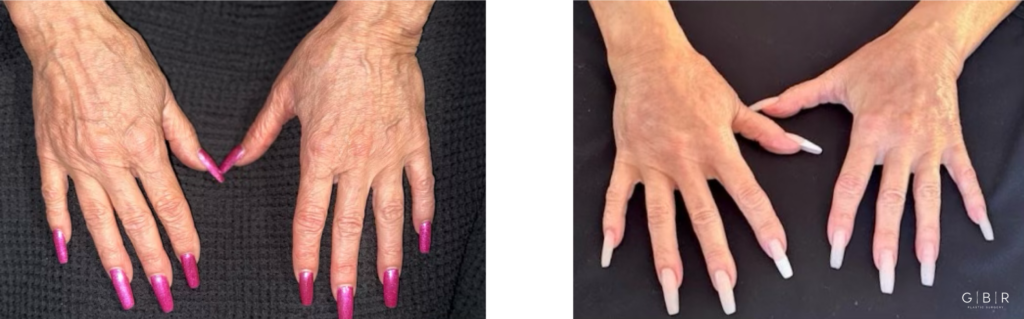 Transformation achieved: A 5-week result of a fat grafting procedure to the hands. Notice the youthful, fuller appearance compared to the initial bony, vein prominent hands. Swelling has mostly resolved, with results nearing their final state.