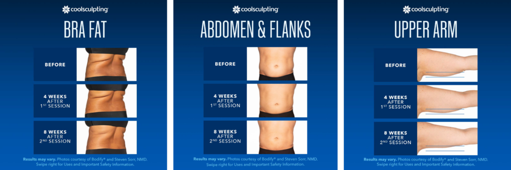 Compilation of before and after comparisons of patients that have undergone Coolsculpting on the path to sculpting their dream body.