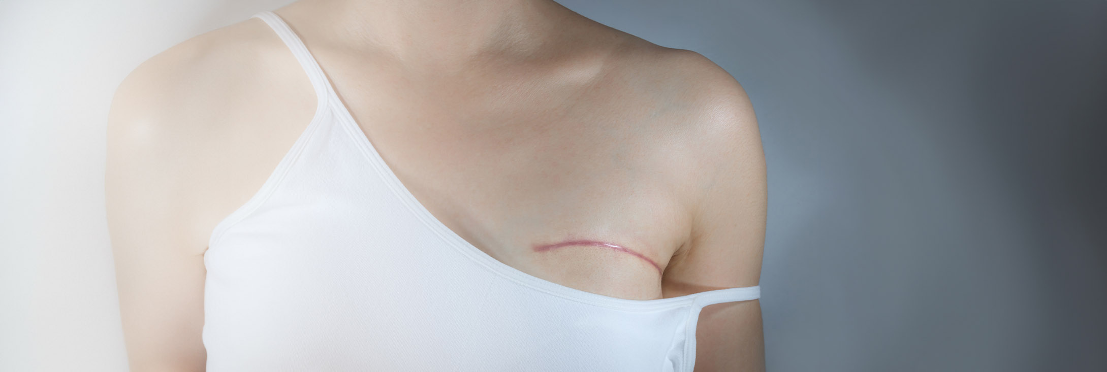 Photo of a woman's upper body after breast reconstruction surgery. She is wearing a white tank top with one of the shoulders down, exposing a surgical scar.