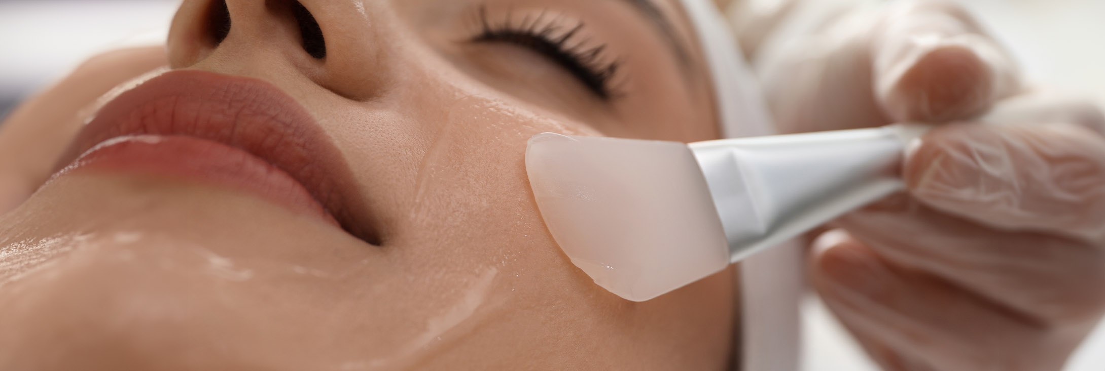 Photo of a woman getting chemical peels