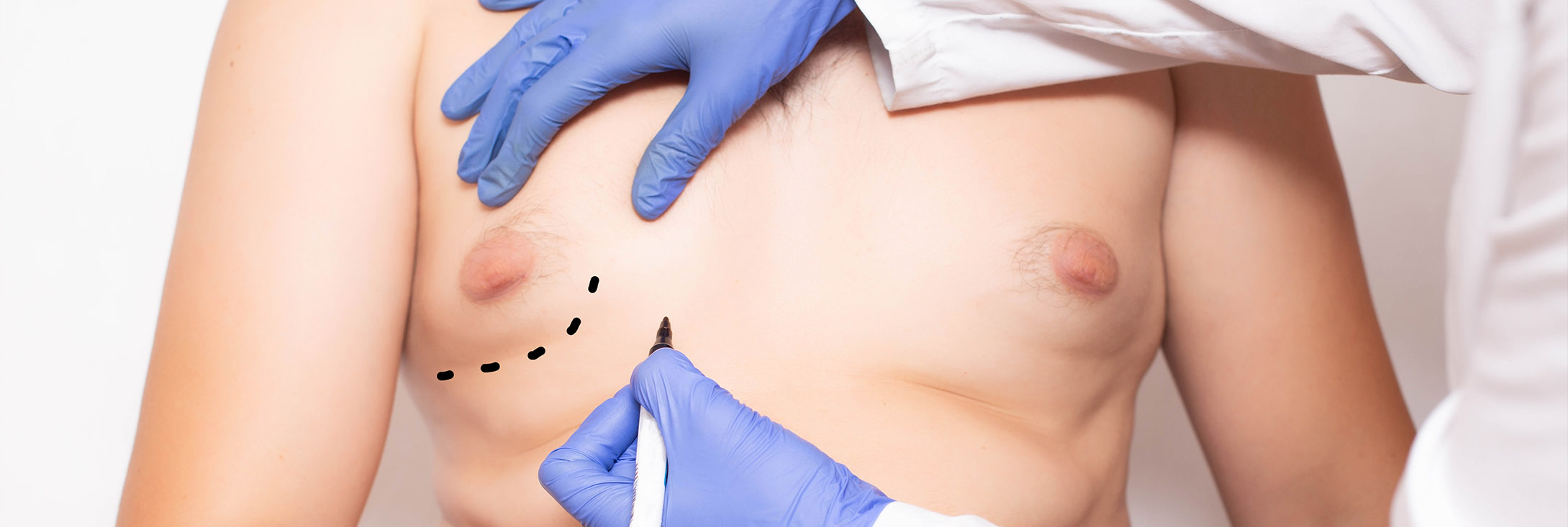 Photo of a man getting a gynecomastia consultation with a plastic surgeon