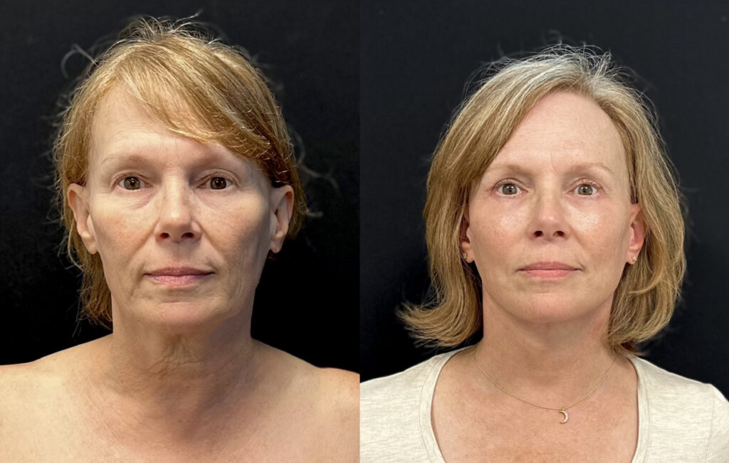 facelift near me