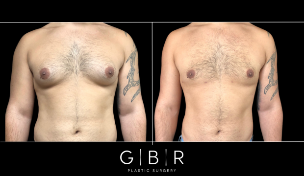 gynecomastia virginia beach