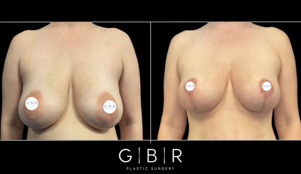 breast lift virginia beach