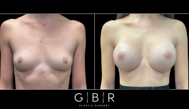 breast augmentation in virginia beach