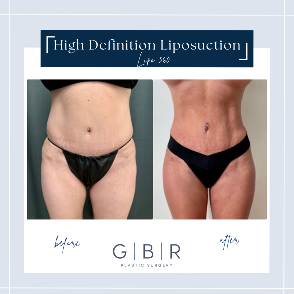 liposuction cost in virginia beach