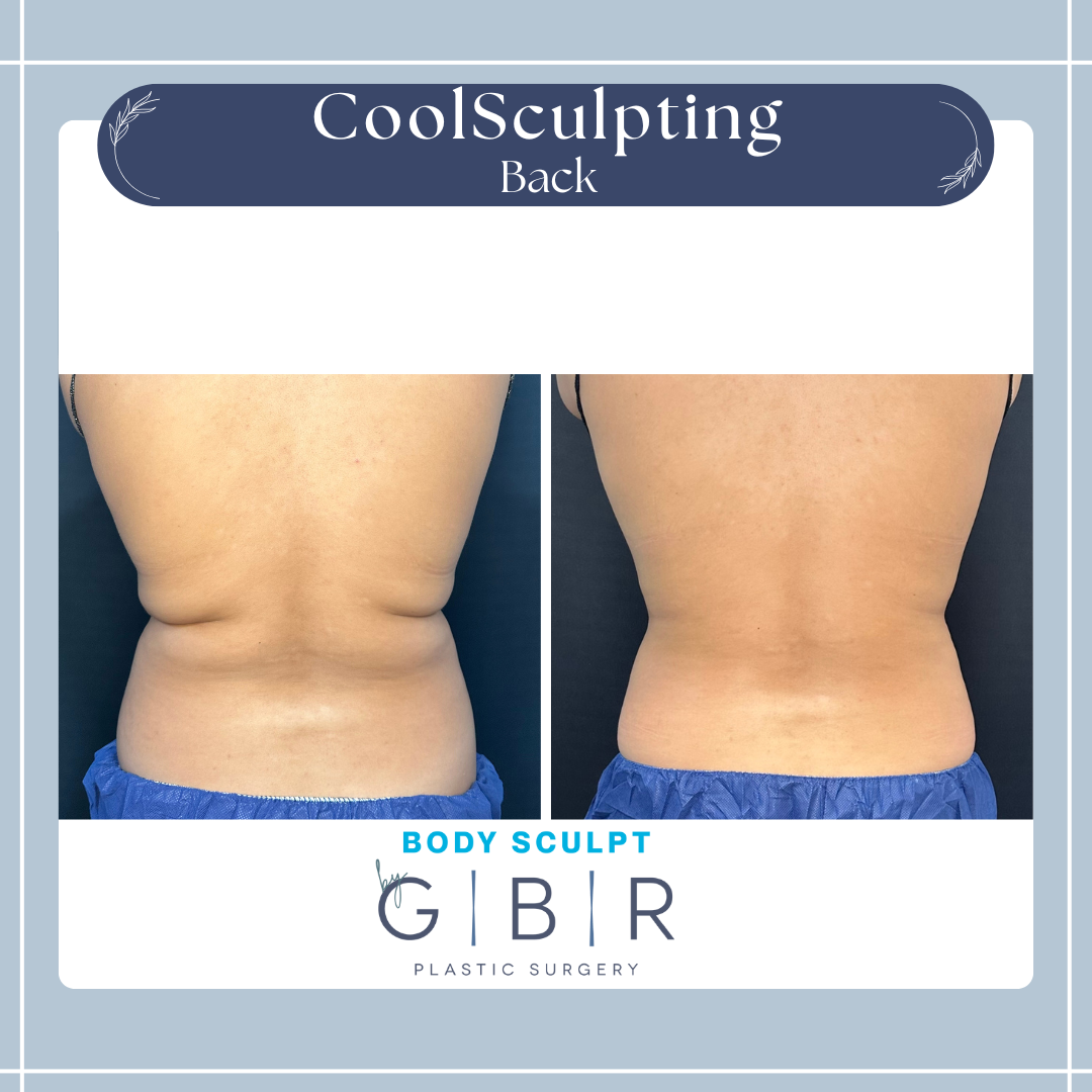 CoolSculpting Virginia beach