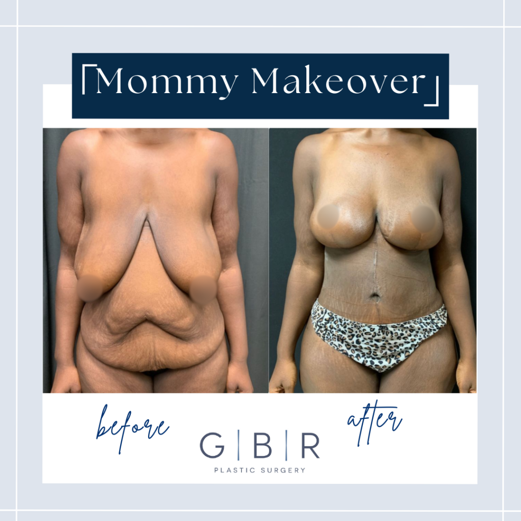 mommy makeover in Virginia beach