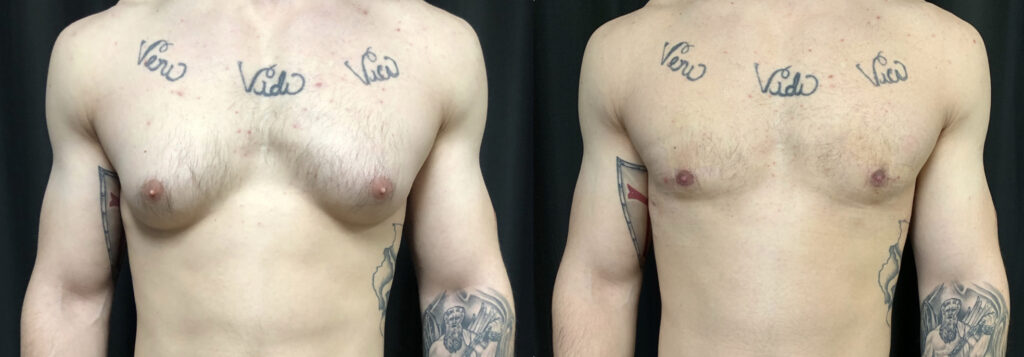 Gynecomastia Virginia beach