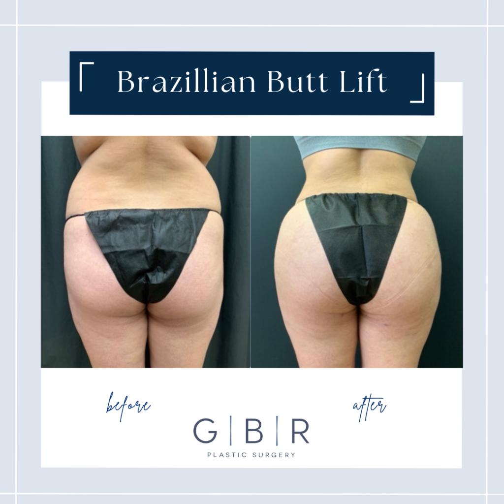 brazilian butt lift in virginia beach