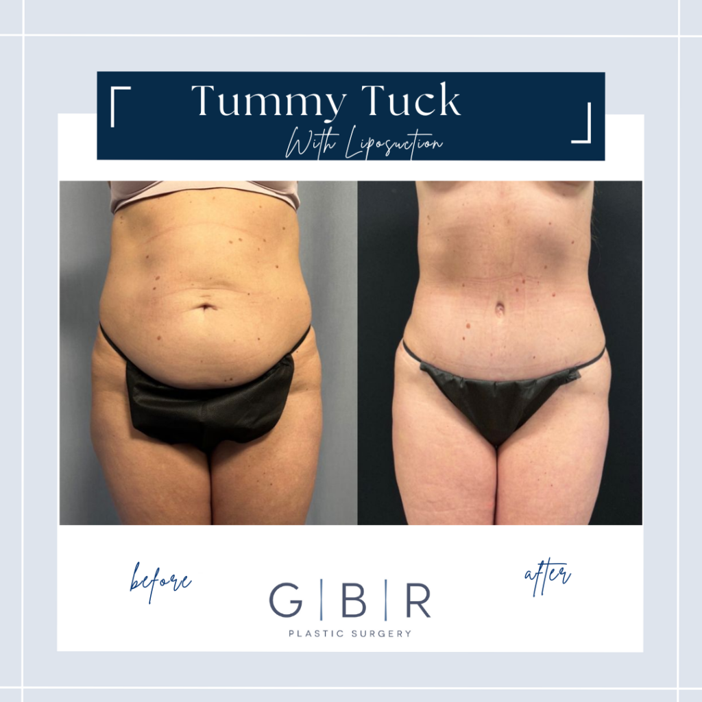 tummy tuck in virginia beach