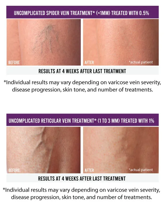 spider vein removal in virginia beach