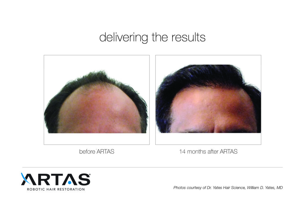 ARTAS iX Hair Restoration