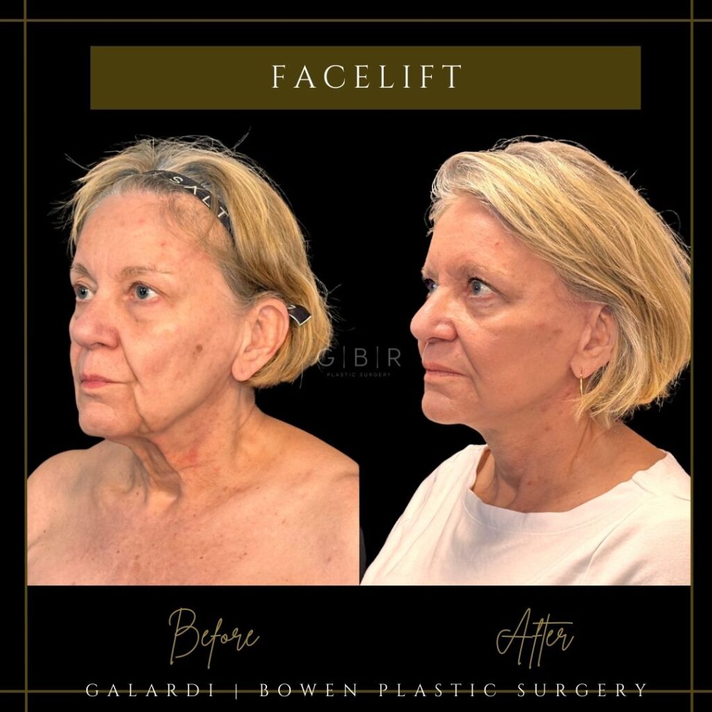 facelift in virginia beach