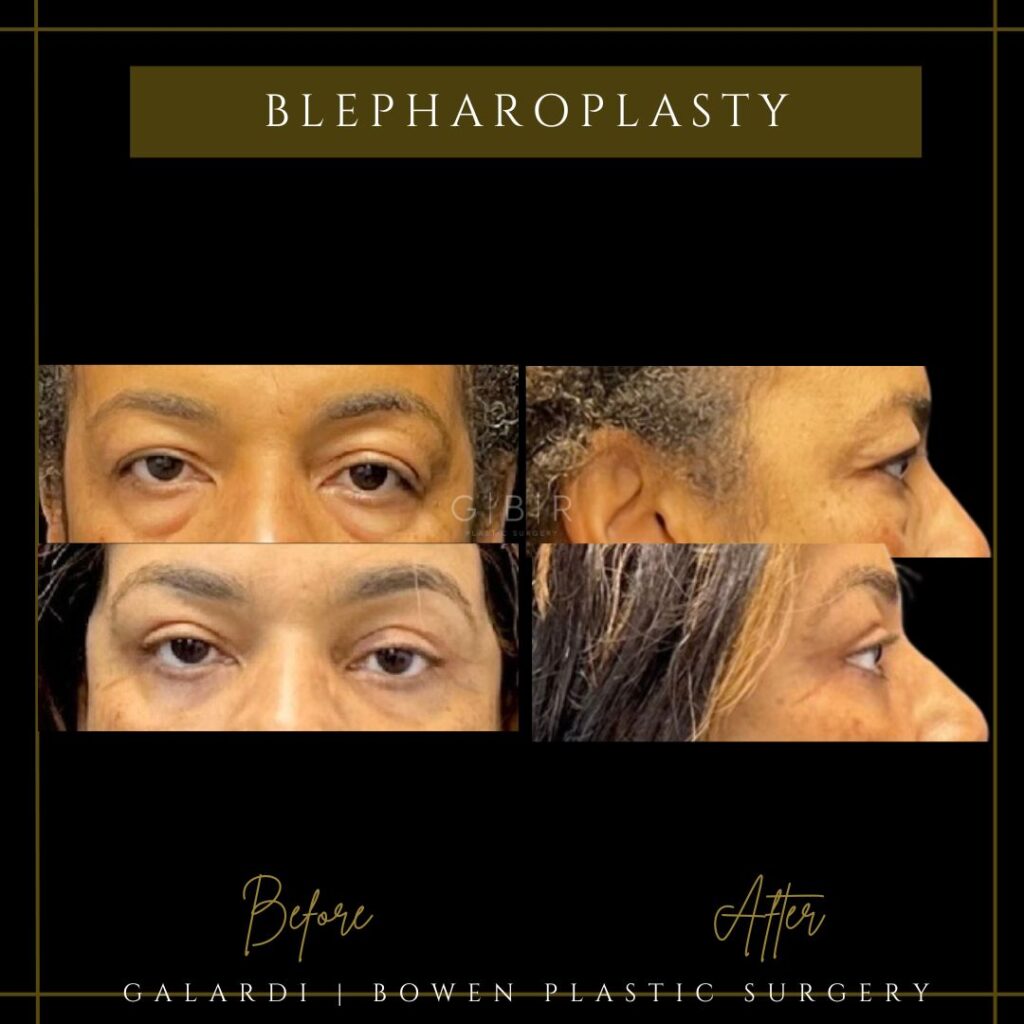 blepharoplasty in virginia beach