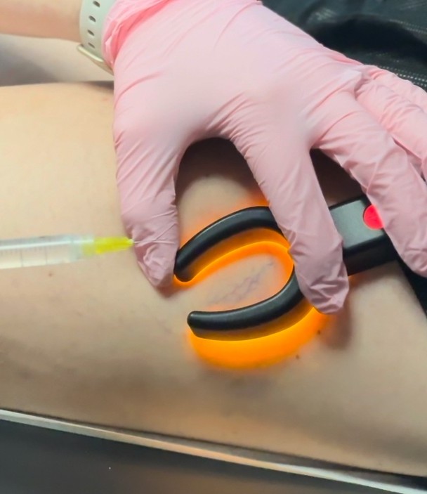 sclerotherapy in virginia beach