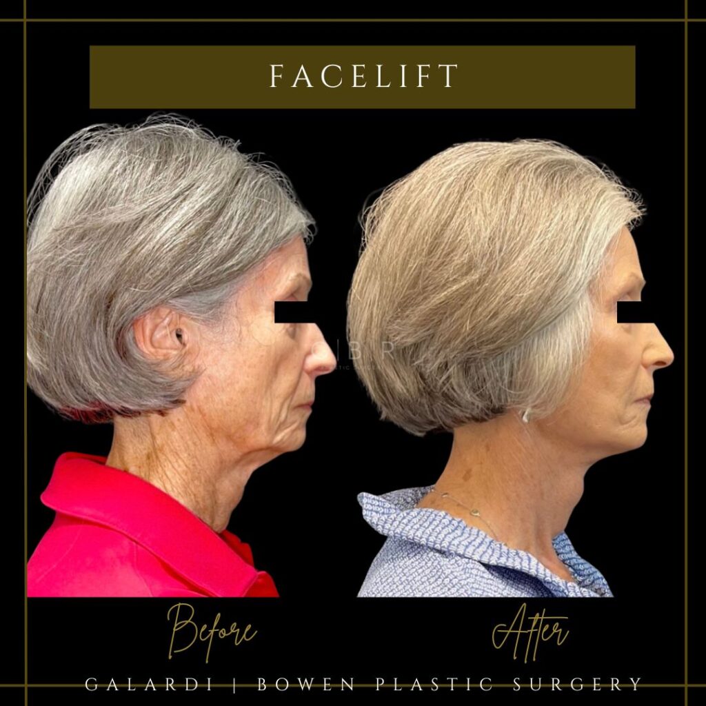 facelift that fixes ozempic face