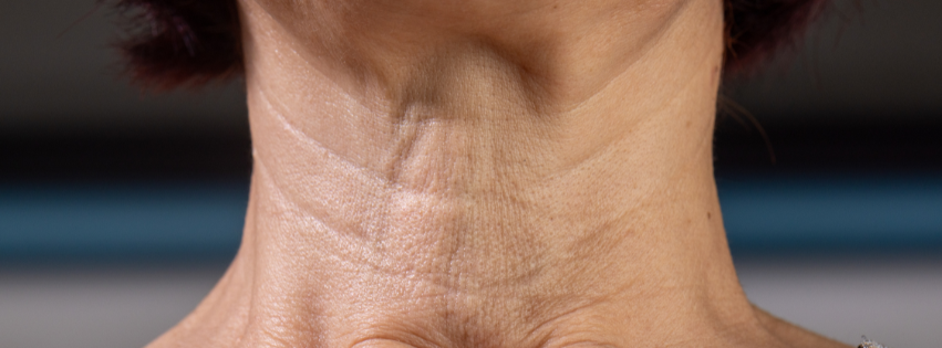neck lift in virginia beach