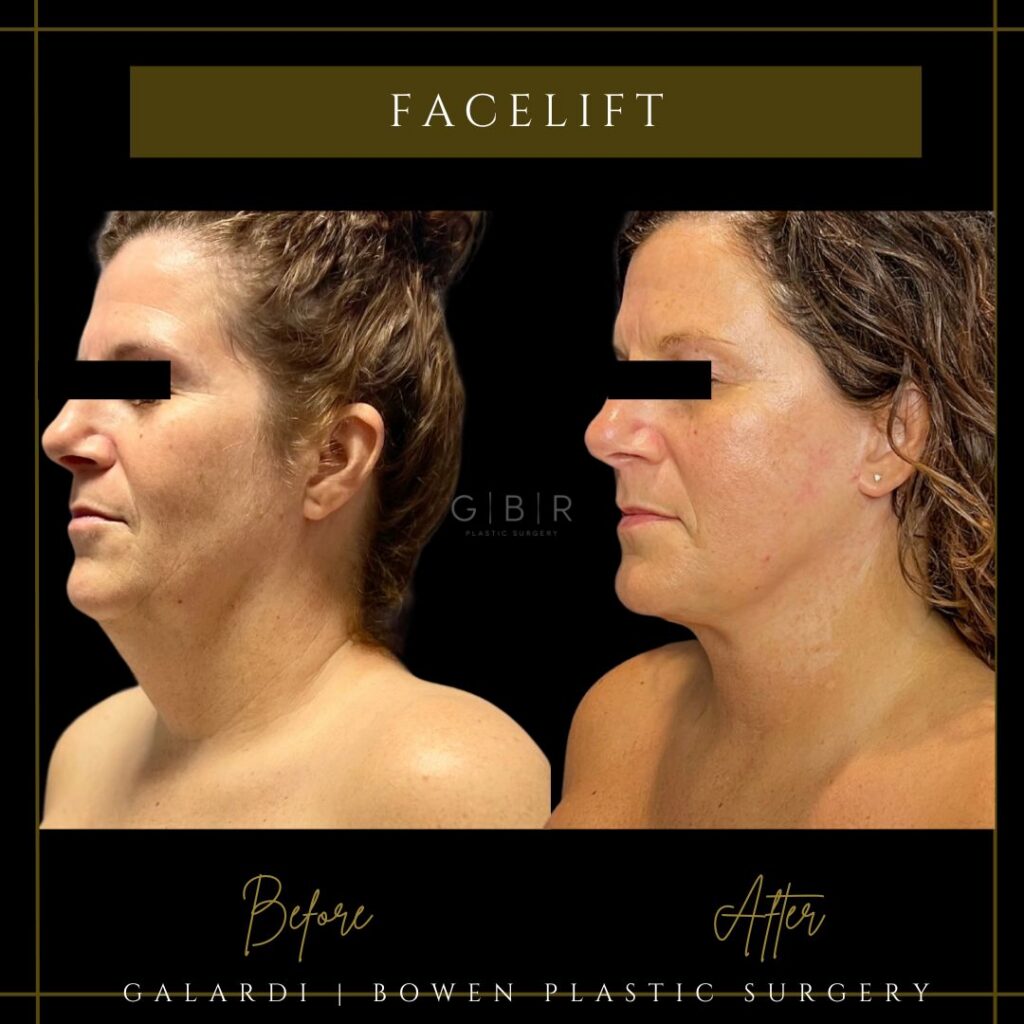Facelift vs Neck Lift