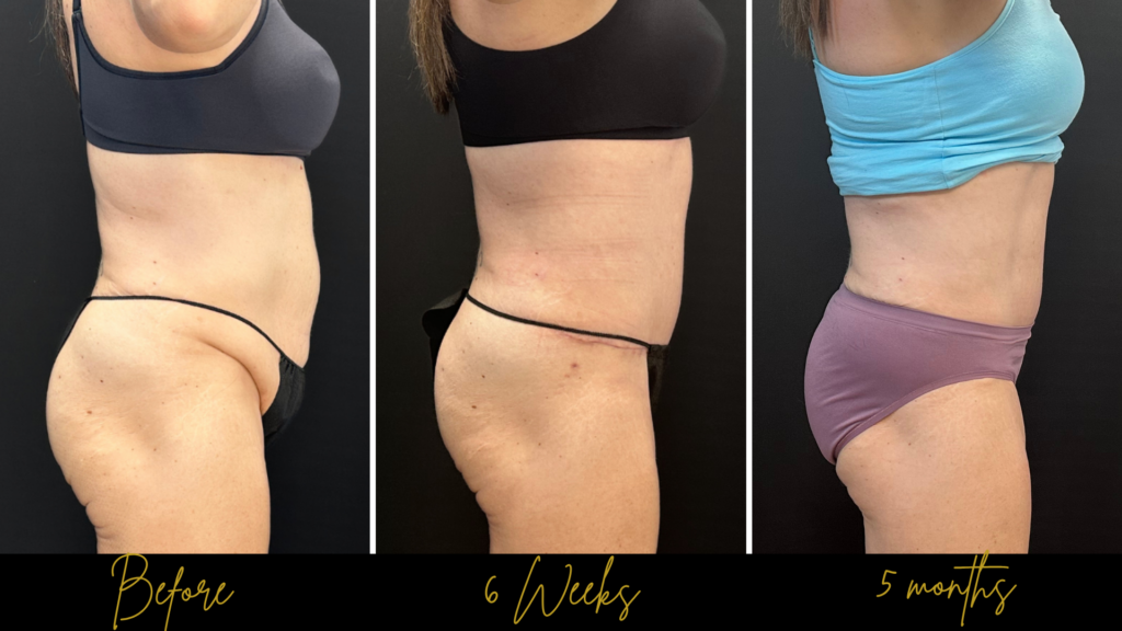 tummy tuck after weight loss in virginia beach