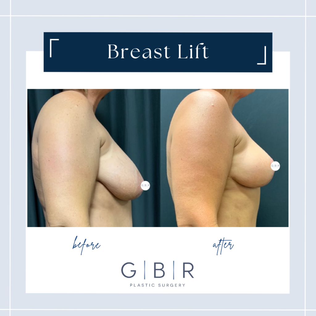 boob lift in virginia beach