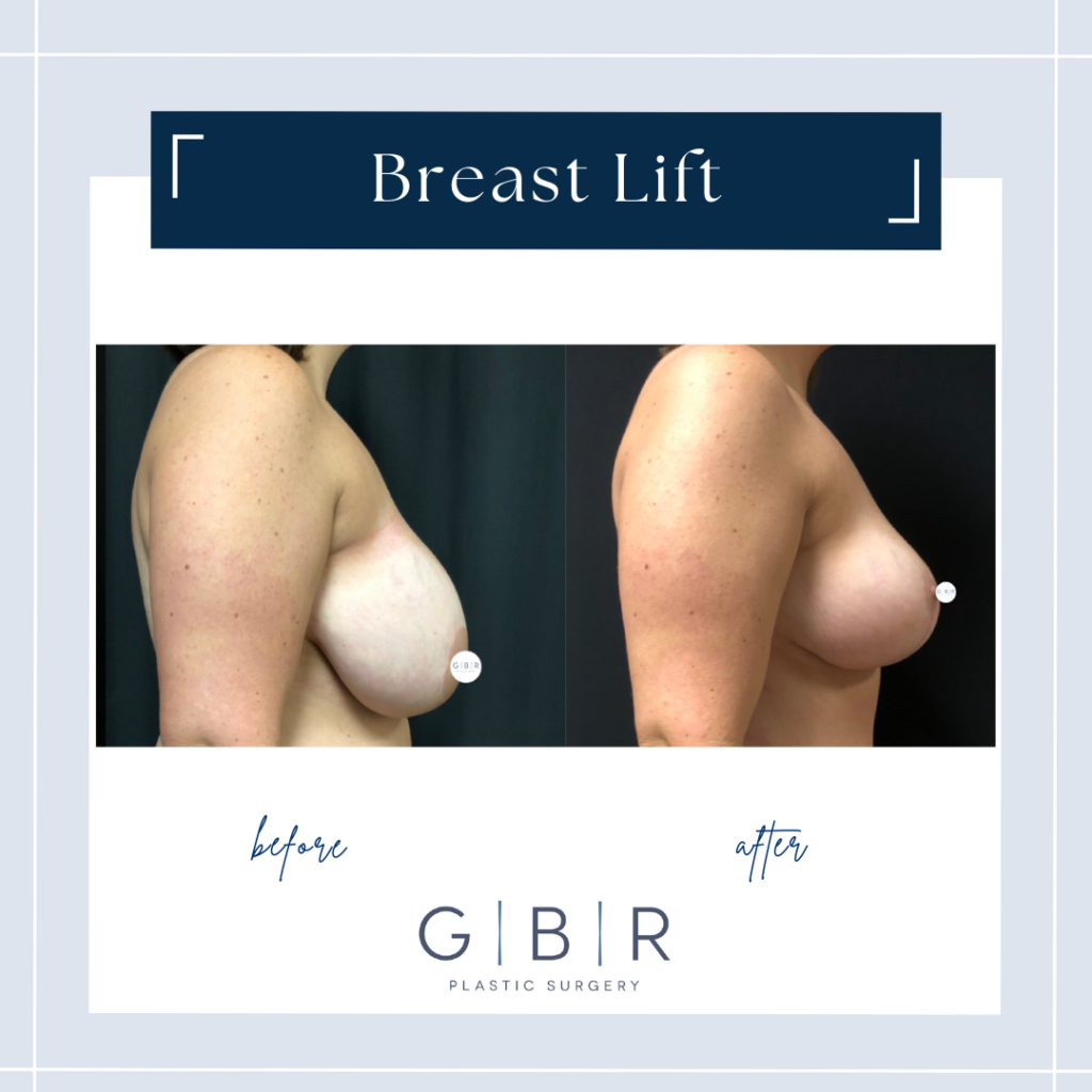 boob lift in virginia beach