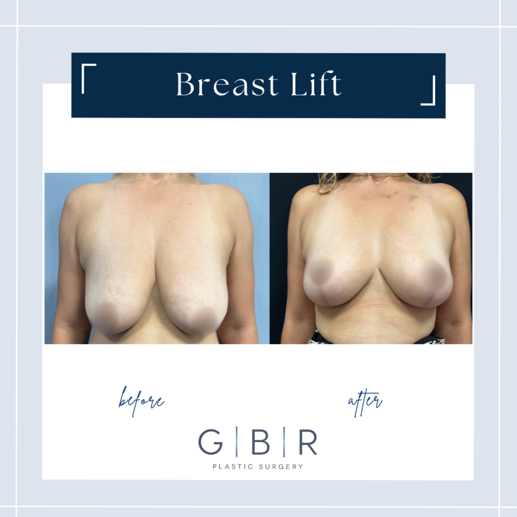 boob lift in virginia beach